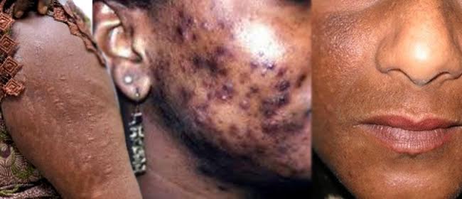 dépigmentation