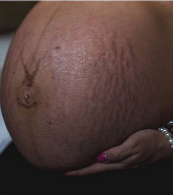 Vergeture et grossesse