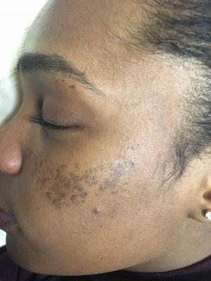 Masque de grossesse